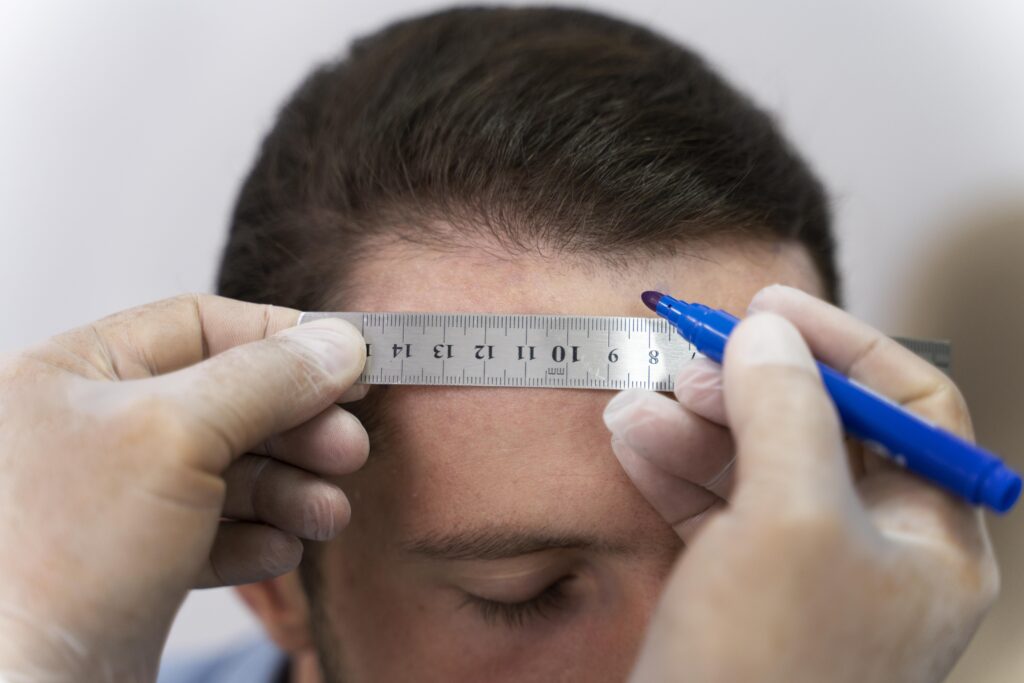 Hair Transplant in pune