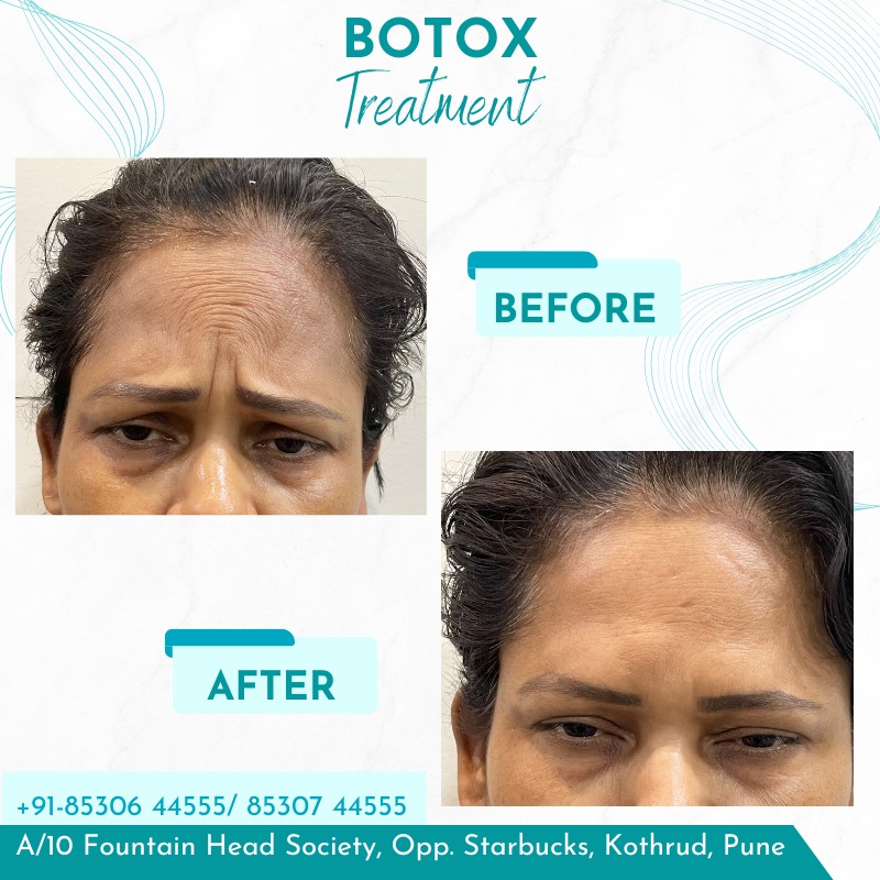 Botox