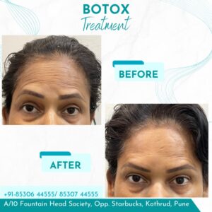 Botox 2