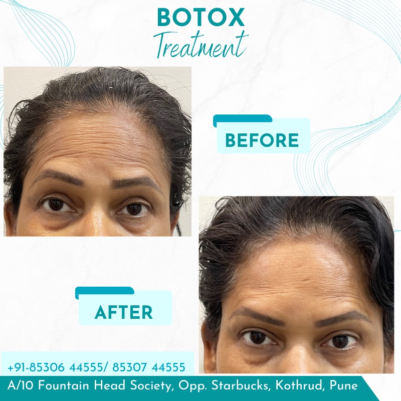 Botox 2