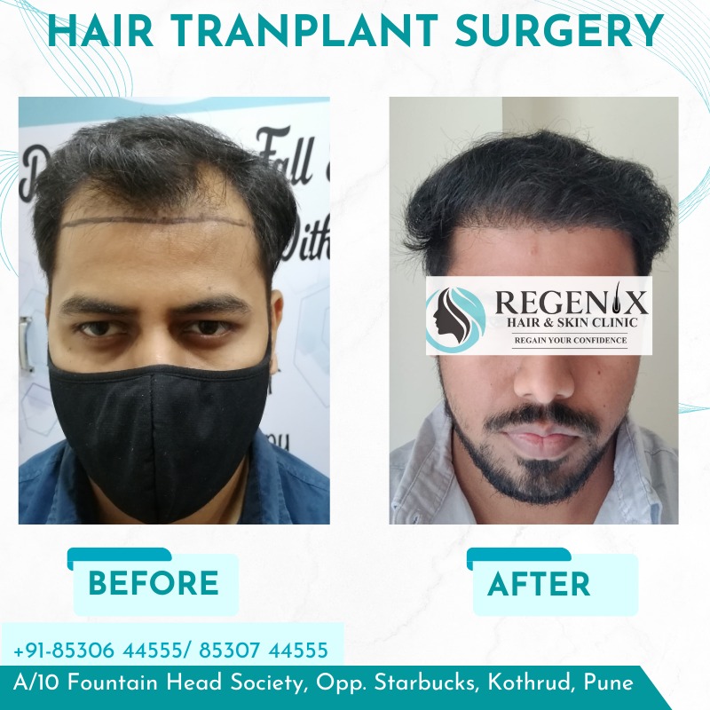 "Top-quality FUE hair transplant