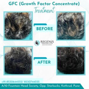 GFC1