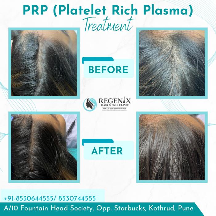 PRP hair transplant in Pune