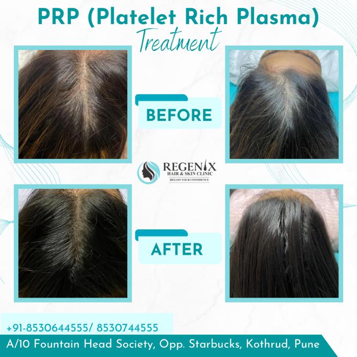 PRP hair treatment