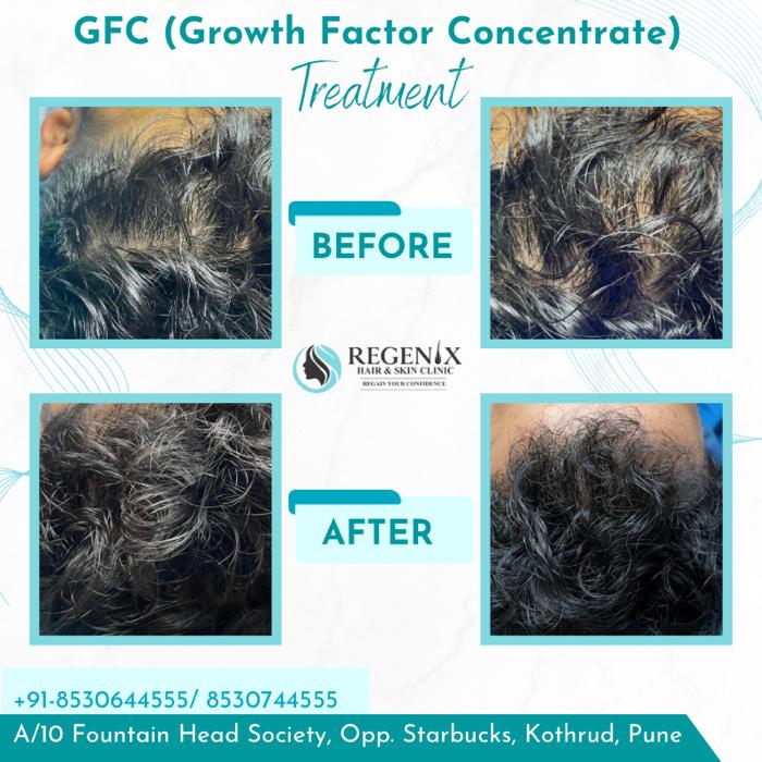 GFC2