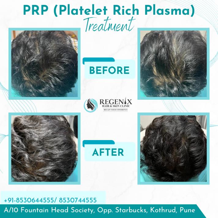 PRP2