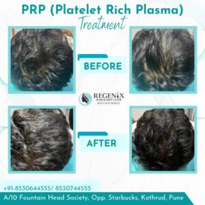 PRP4